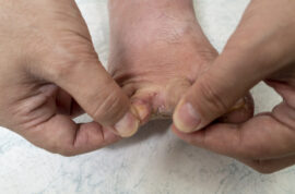 Tinea pedis