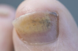 Big toe with fungal growth on the toenail