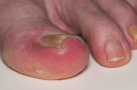 Ingrown toenail onychocryptosis on caucasian big toe Hallux, caused by fungal infection tinea unguium.