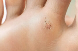 wart on a blunt close-up. Macro shot of human papilloma on the foot
